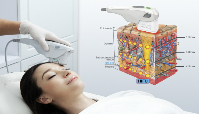 Manfaat Teknologi High Intensity Focused Ultrasound Untuk Wajah