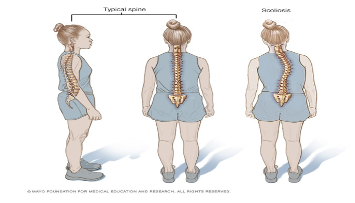 Penyebab Penyakit Skoliosis Dari Kebiasaan Sehari-Hari