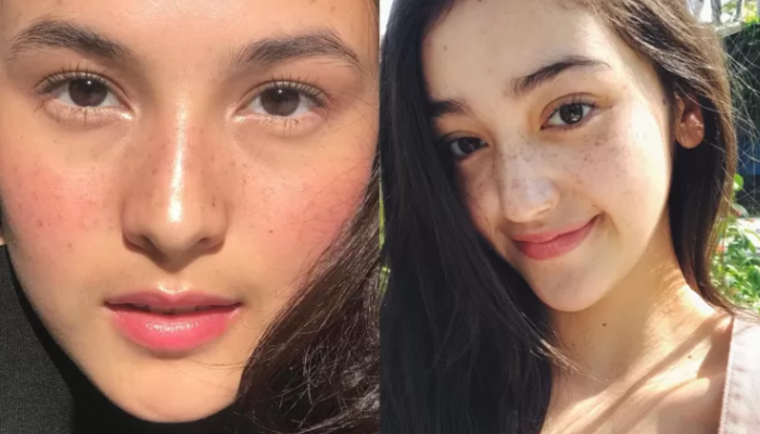 Freckles Cenderung Terjadi Pada Orang Bule, Mengapa Demikian?