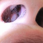 Penyakit Polip Menyebabkan Kanker Jika Tidak Tepat Di Tangani