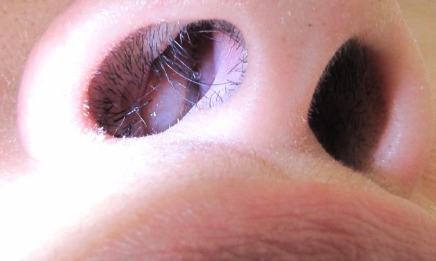 Penyakit Polip Menyebabkan Kanker Jika Tidak Tepat Di Tangani