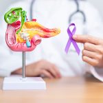 Mencegah Kanker Pankreas Dengan Pola Hidup Sehat